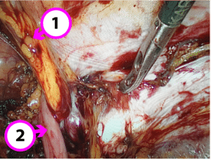 Laparoscopic Repair of Femoral Hernia - Colorectal and Gastro