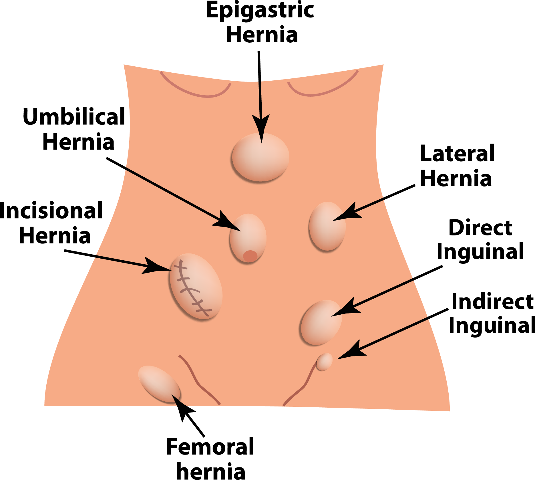 Notice a Bulge? Could it be a Hernia? 2 shutterstock 1169640184 Hernias 1